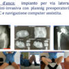 Post operatorio protesi d'anca Brescia